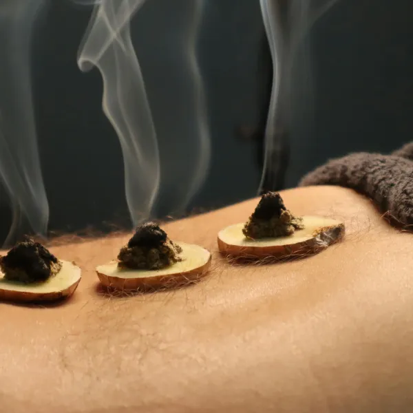 moxibustion